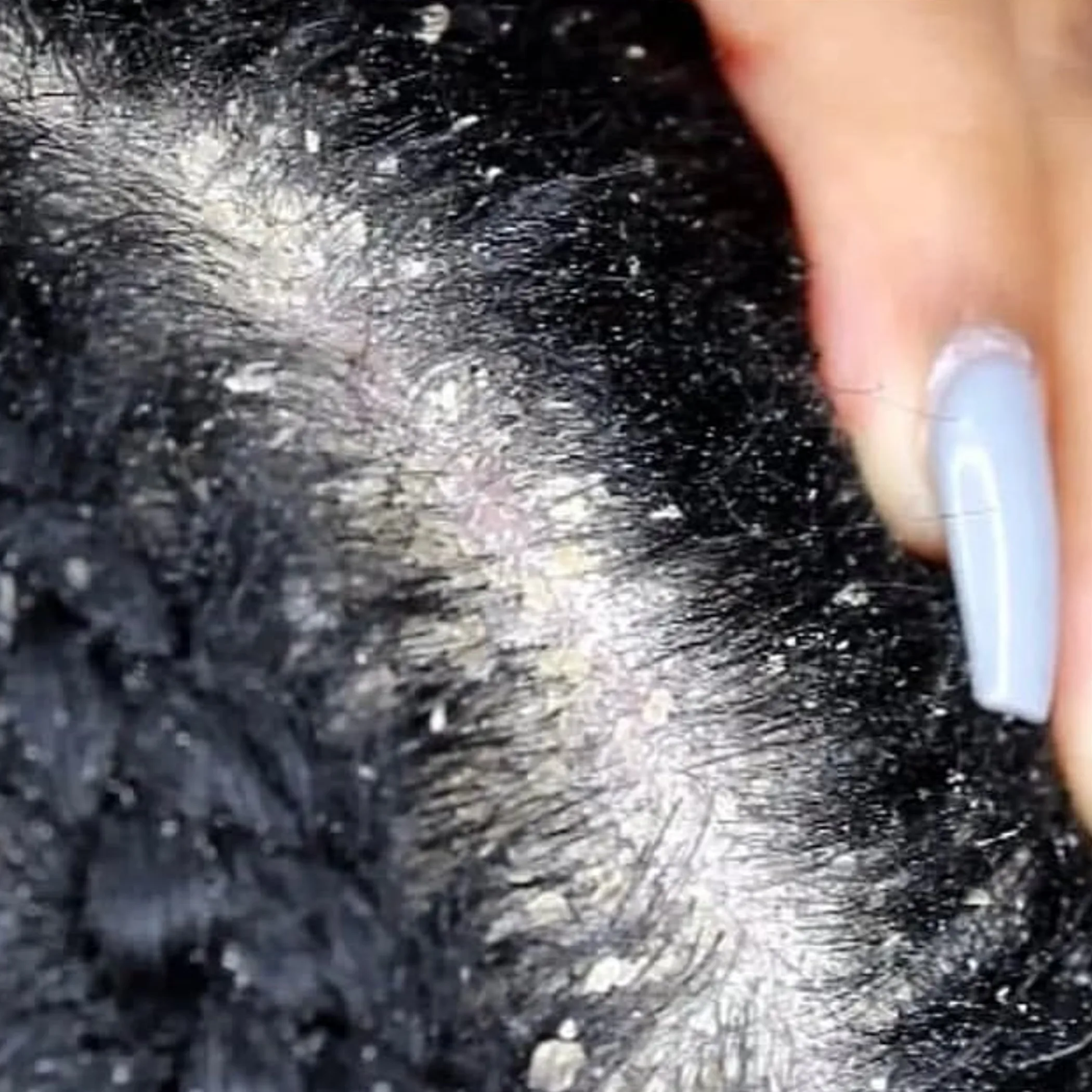 detailed view sebaceous glands hair follicles
